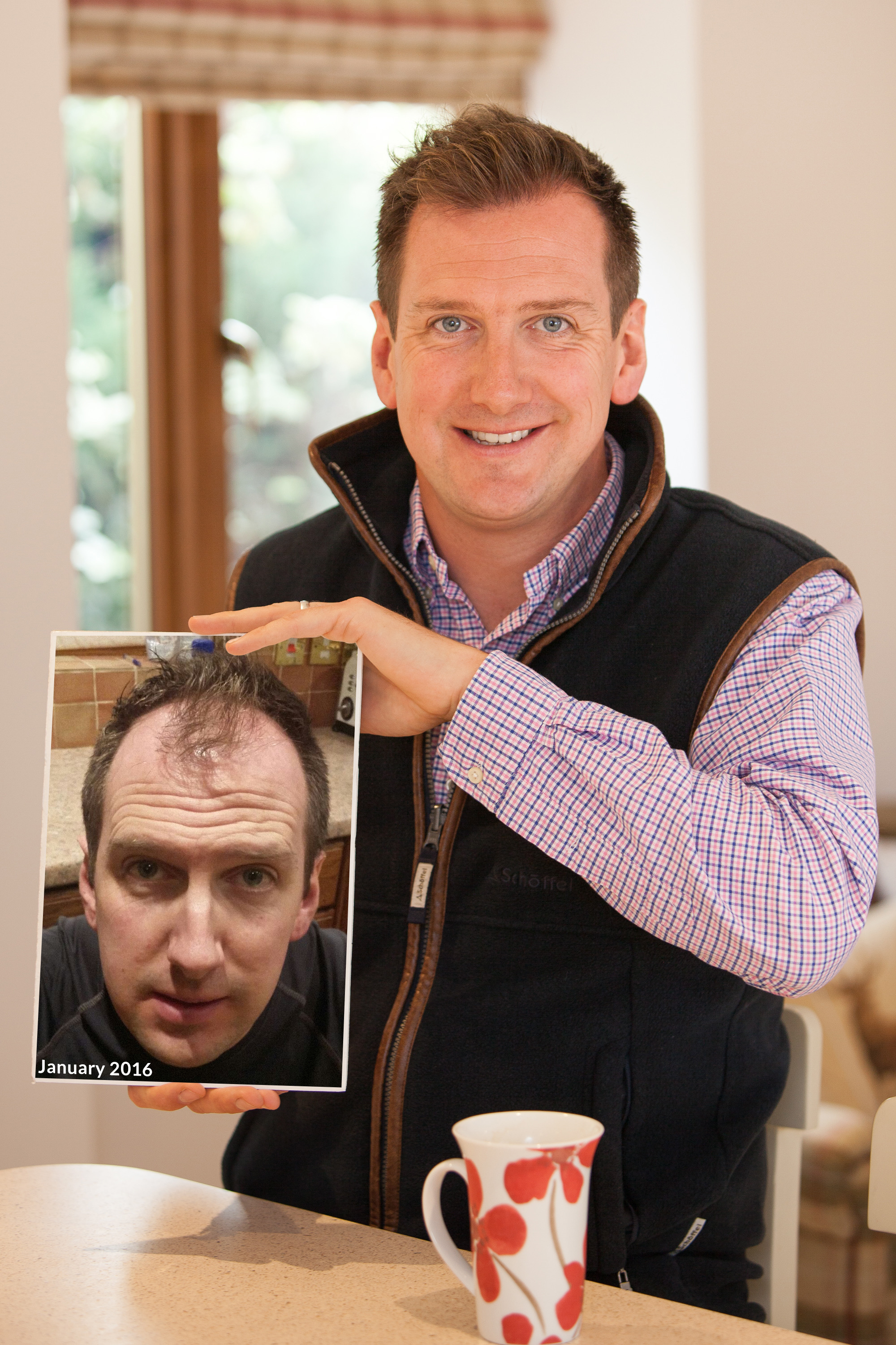 Are you a good candidate for hair transplant surgery? - Dr Bonaros